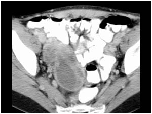 Case of the month November 2006: Various malignant intra abdominal tumors