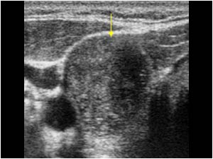 Papillary thyroid carcinoma with an irregular hypoechoic mass
