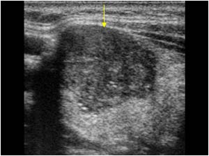 Papillary thyroid carcinoma with an irregular hypoechoic mass