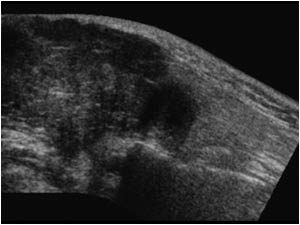 Parotid gland and irregular hypoechoic tumor