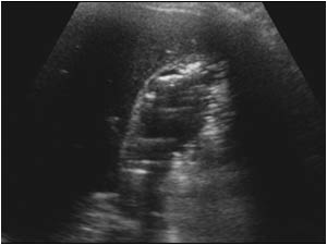 Emphysematous cholecystitis with air in the gallbladder