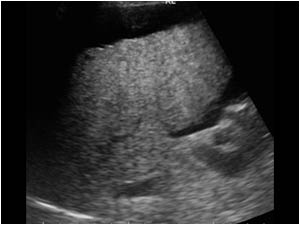 Liver cirrhosis with an irregular liver contour and ascites