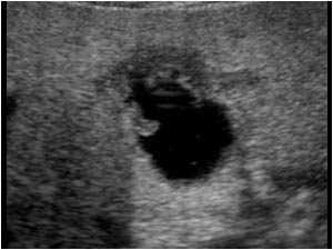 Irregular thickening of the wall of the gallbladder fundus