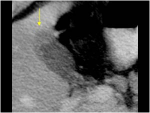 Irregular thickening of the wall of the gallbladder fundus CT scan