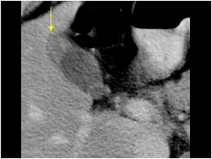 Irregular thickening of the wall of the gallbladder fundus CT scan