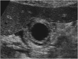 Edematous thickening of the gallbladdder wall transverse
