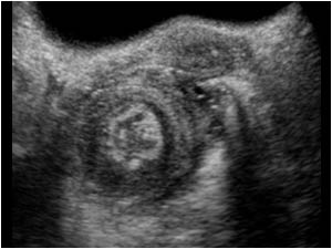 Intussusception of the rectum with a mass dorsal of the uterus transverse