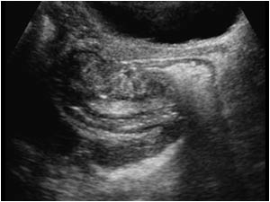 Intussusception of the rectum with a mass dorsal of the uterus longitudinal