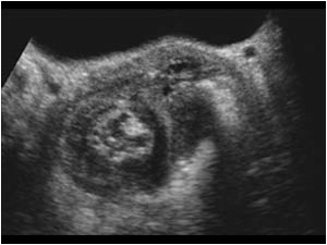 Intussusception of the rectum with a mass dorsal of the uterus transverse