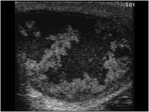 Epididymitis on the right side with caseous changes