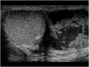 Normal testicle and epididymitis on the right side with caseous changes