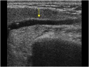Dilatated main duct of the right parotid gland