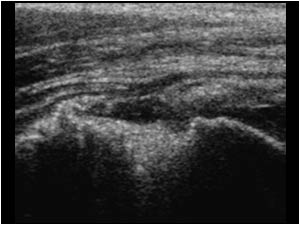 Avulsion of the supraspinatus tendon insertion longitudinal