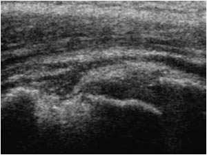 Avulsion of the supraspinatus tendon insertion longitudinal