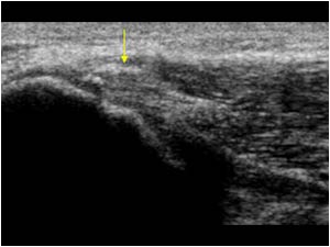 Flexor tendon with calcifications longitudinal
