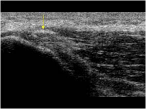 Flexor tendon with calcifications longitudinal
