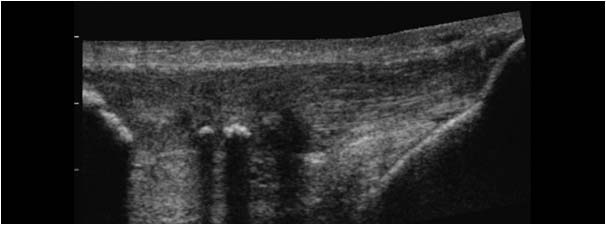 Tendinosis and calcifications extended field of view