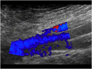 Slow flow in the right femoral veins longitudinal