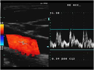 Normal doppler signal in the right common carotid artery