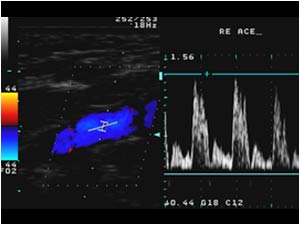 Normal doppler signal in the right external carotid artery
