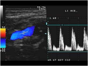 Normal doppler signal in the left external carotid artery