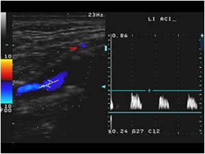High resistence doppler signal in the left internal carotid artery
