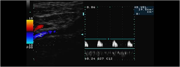 High resistence doppler signal in the left internal carotid artery with low velocity