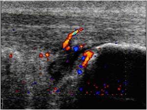 Vascularity in the achilles tendon and bursa wall