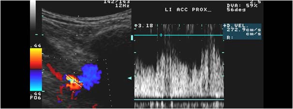 High systolic velocity in the proximal common carotid artery