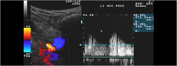 High systolic and diastolic velocity in the proximal common carotid artery