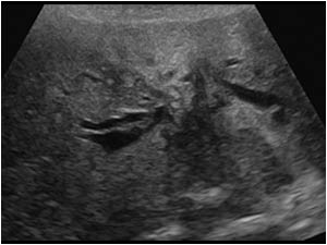 Klatskin tumor (cholangiocarcinoma) with an irregular mass in the liver hilum