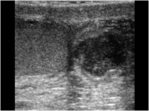 Small abscess in the tail of the epididymis
