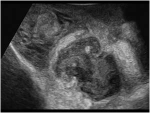 Large intrascrotal abscess