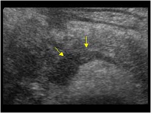 Tumor thrombus in the splenic vein and superior mesenteric vein