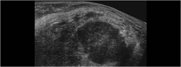 Gynaecomastia and a large infiltrating ductal carcinoma extended field of view