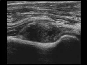Synovial thickening in the annular recess longitudinal