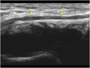 Synovial thickening displacing the ulnar nerve longitudinal