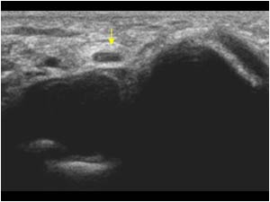 Synovial thickening displacing the ulnar nerve transverse