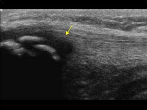 Cartilage swelling of the lowerpole of the patella longitudinal