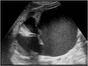 Echogenic urine in the pelvicalyceal system longitudinal