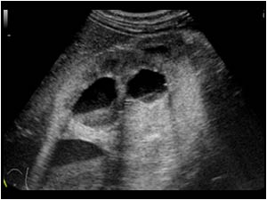 Echogenic urine and sedimentation in the calyceal system