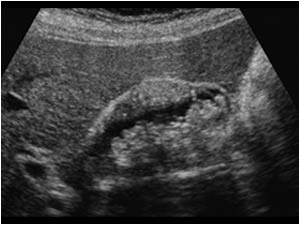 Adenomyomatosis of the gallbladder with a thickened wall longitudinal
