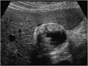 Adenomyomatosis of the gallbladder with a thickened wall transverse