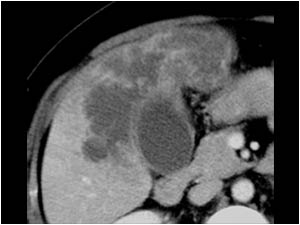 Gallbladder carcinoma