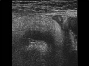 Inflamed diverticulum and fat
