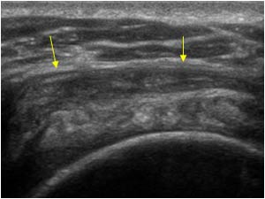 Right shoulder bursa thickening transverse
