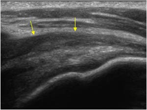 Right shoulder bursa thickening longitudinal