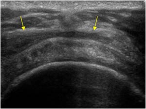 Right shoulder bursa thickening transverse