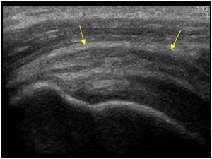 Left shoulder bursa thickening longitudinal