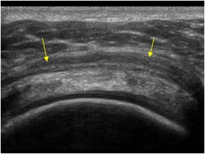 Left shoulder bursa thickening transverse
